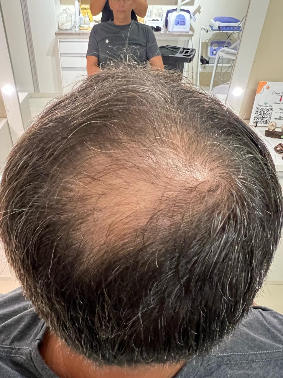 Antes do acompanhamento: Alopecia androgenética masculina
