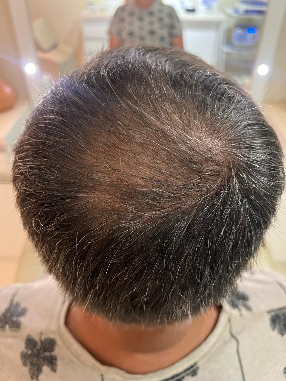 Depois do acompanhamento: Alopecia androgenética masculina